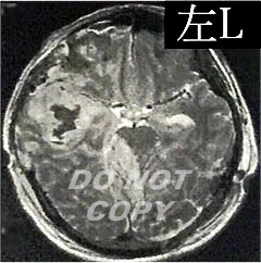事故直後の頭部CT